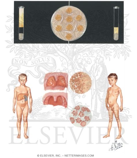 Abetalipoproteinemia and Tangier Disease