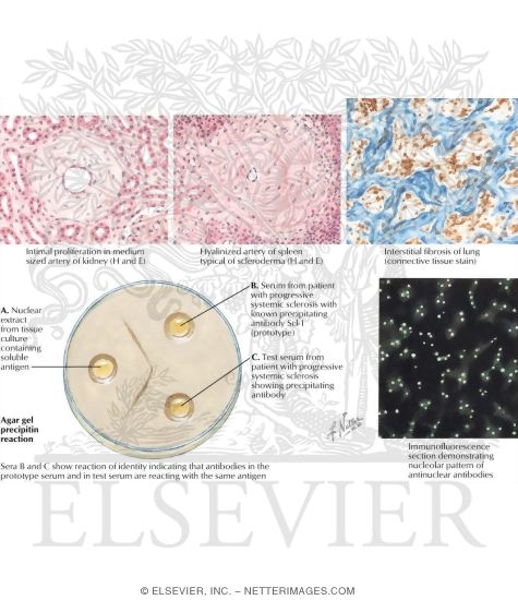 Progressive Systemic Sclerosis (Scleroderma)