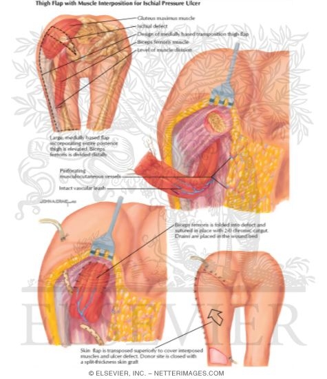 Thigh Flap with Muscle Interposition for Ischial Pressure Ulcer