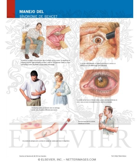 Manejo Del Síndrome De Behçet