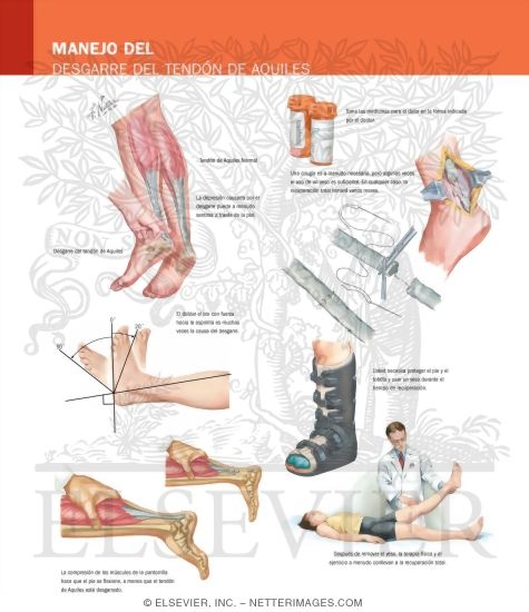 Managing Your Achilles Tendon Rupture