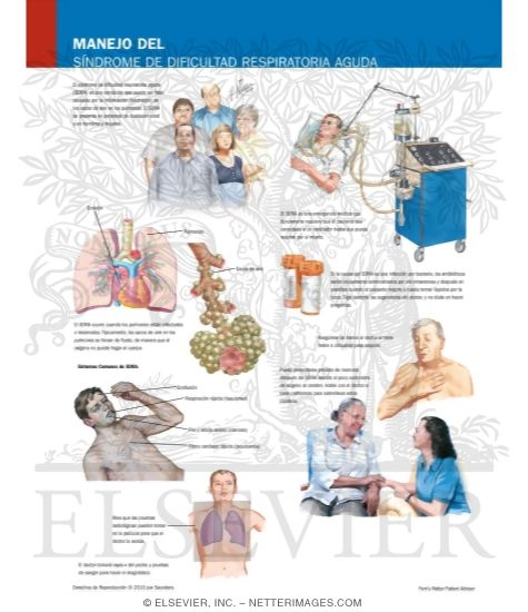 Manejo Del Síndrome de Dificultad Respiratoria Aguda