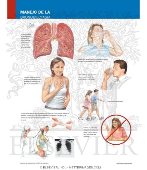 Manejo de la Bronquiectasia