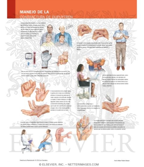 Manejo de la Contractura de Dupuytren