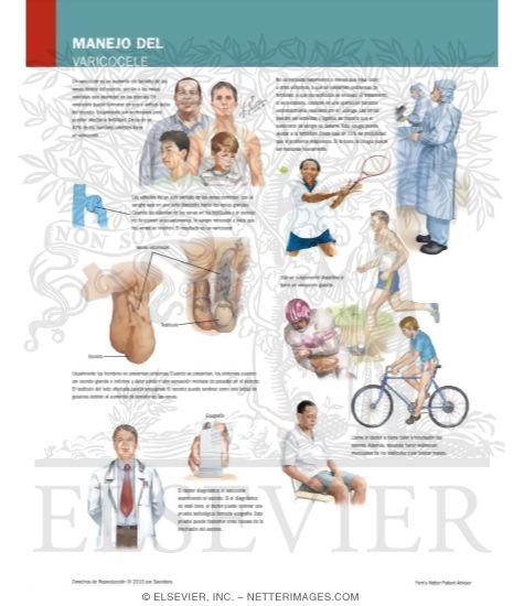Manejo Del Varicocele