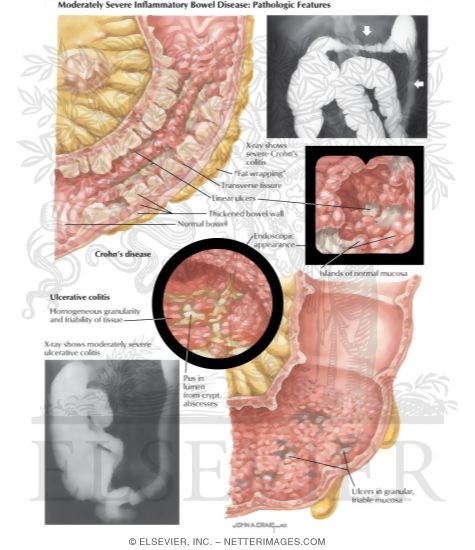 Inflammatory Bowel Disease: Moderately Severe Inflammatory Bowel Disease - Pathologic Features