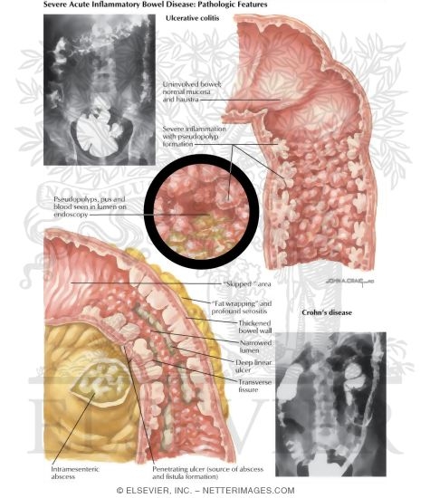 Inflammatory Bowel Disease: Severe Acute Inflammatory Bowel Disease - Pathologic Features