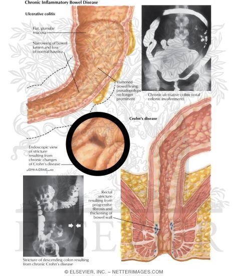 Inflammatory Bowel Disease: Chronic Inflammatory Bowel Disease