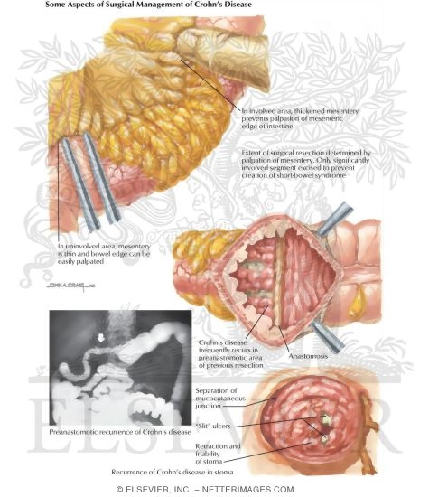 Inflammatory Bowel Disease: Some Aspects of Surgical Management of Crohns Disease