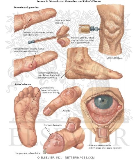 Sexually Transmitted Diseases: Lesions in Diseminated Gonorrhea and Reiter's Disease