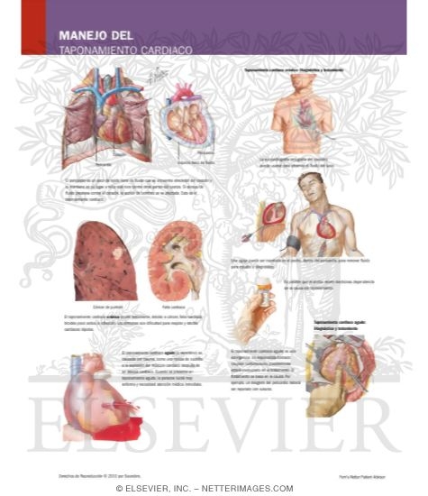 Manejo Del Taponamiento Cardiaco