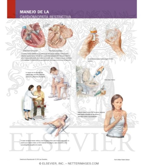 Manejo de la Cardiomiopatía Restrictiva
