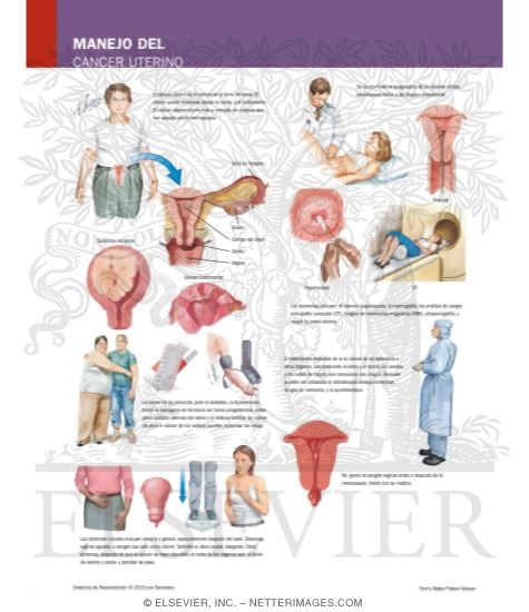 Manejo Del Cancer Uterino
