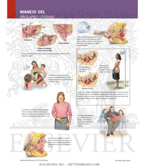 Manejo Del Prolapso Uterino