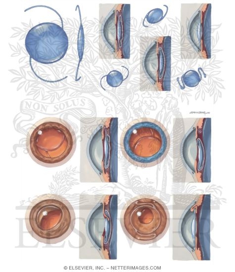 Cataracts Intraocular Lens (IOL)