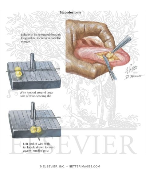 Stapedectomy