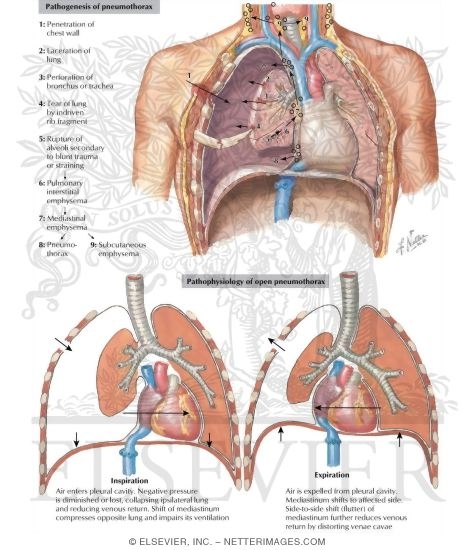 Pathogenesis of Pneumothorax; Pathophysiology of Open Pneumothorax
