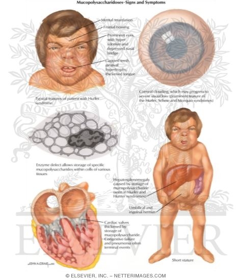 Birth Defects Mucopolysaccharidoses-Signs And Symptoms
