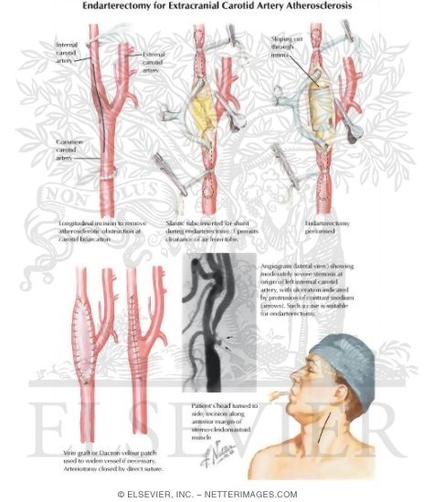 Extracranial Carotid Artery