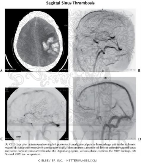 Sagittal Sinus Thrombosis