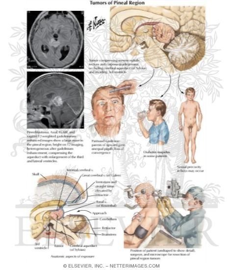Tumors of Pineal Region