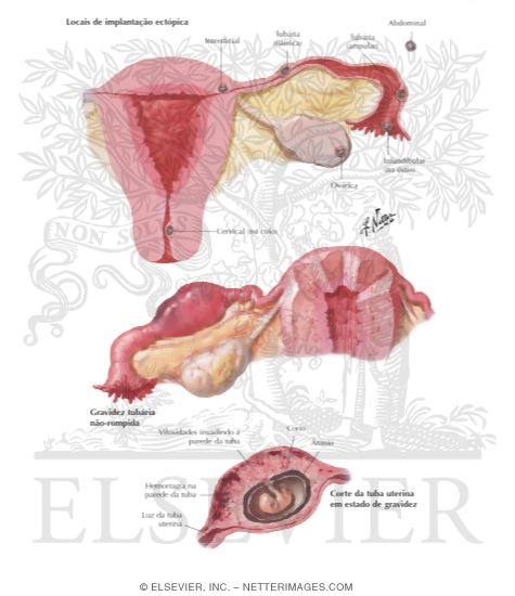 Gravidez Ectopica