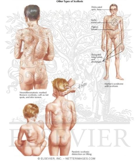 Neurofibromatosis, Marfan's Syndrome, Paralytic Scoliosis