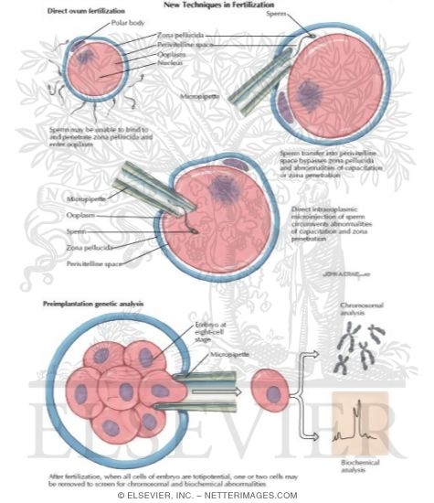 New Techniques in Fertilization