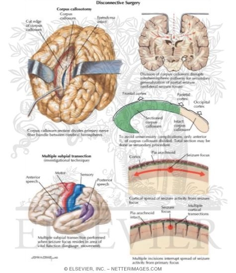 Disconnective Surgery