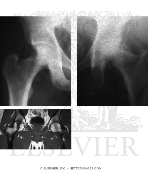 Stages of Osteonecrosis of the Femoral Head
