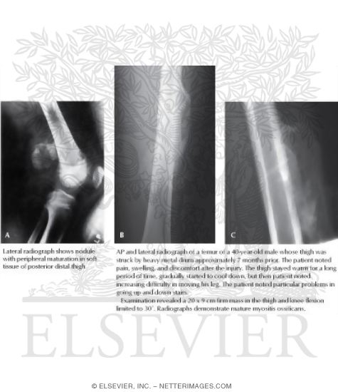Myositis Ossificans