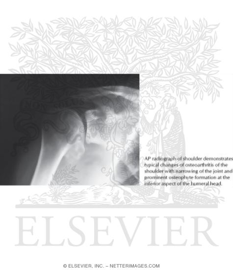 Osteoarthritis of the Shoulder