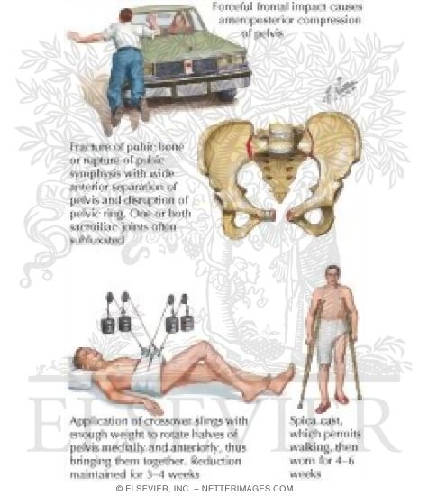 Anteroposterior Compression Fracture of Pelvis (Open Book Fracture)
