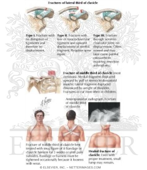 Clavicular Fractures