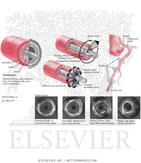 Intravascular Ultrasonography