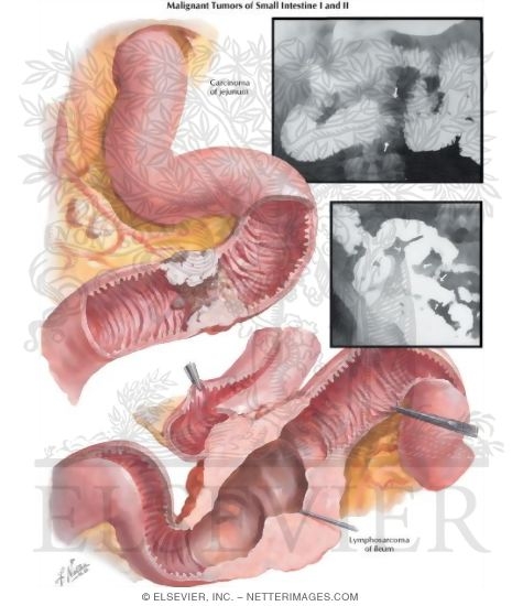 Malignant Tumors of Small Intestine I and II