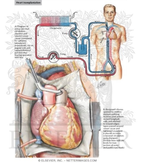 HEART TRANSPLANTation