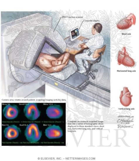 Stress Nuclear Imaging by Single-Photon Emission CT (SPECT)