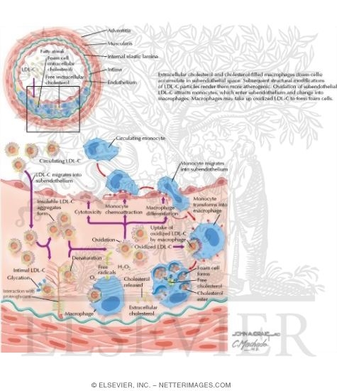 Atherogenesis: Fatty Streak Formation