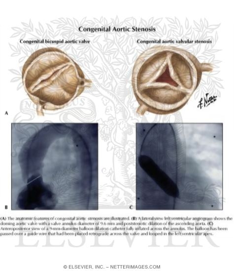 Congenital Aortic Stenosis