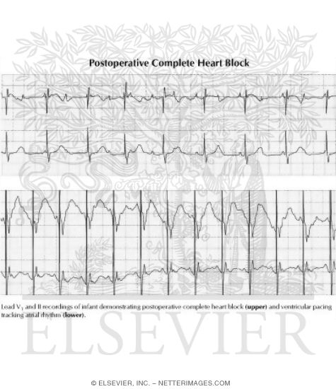 Complete Heart