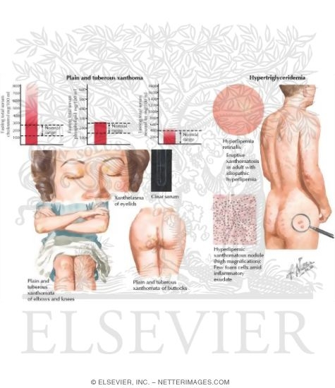 Hypercholesterolemic Xanthomatosis