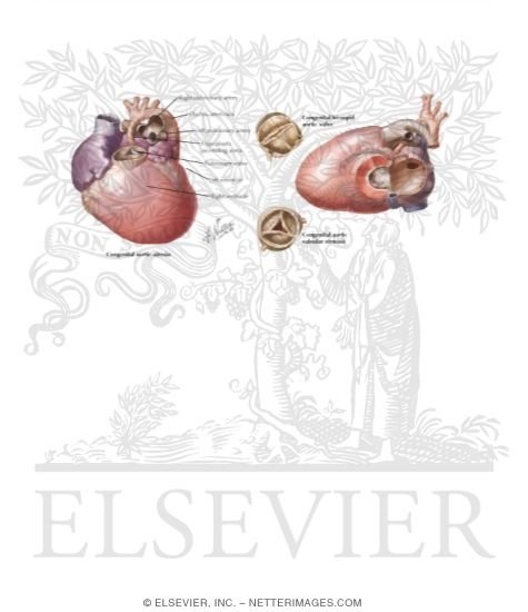Anomalies of the Left Ventricular Outflow Tract