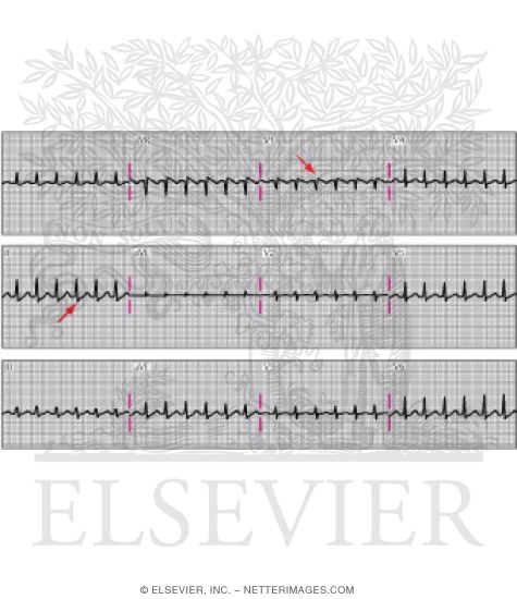 Atrioventricular Nodal Reentrant Tachycardia