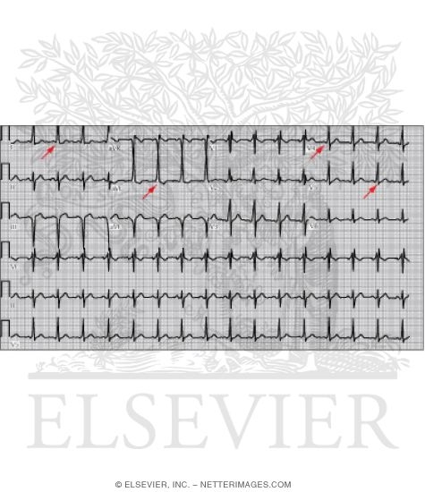 Wolff-Parkinson-White Pattern With Delta Waves Highlighted By Arrows
