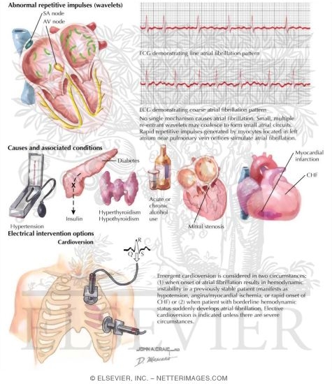 Atrial Fibrillation