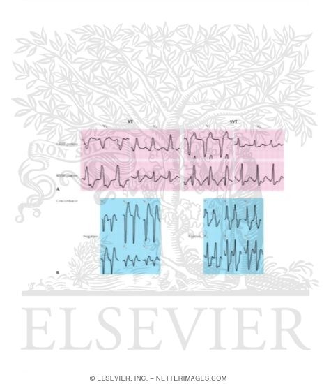 Changes In QRS Morphology In Ventricular Tachycardia (VT)