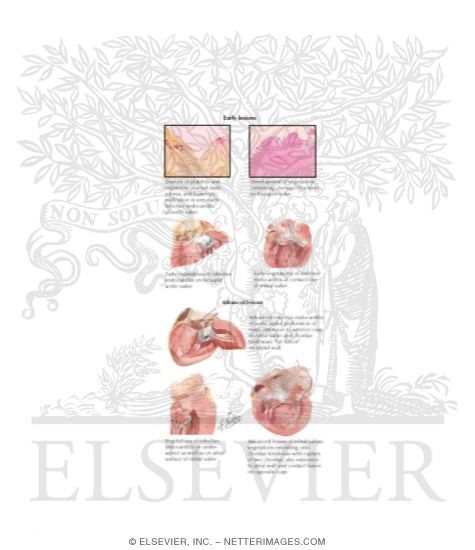 Infective Endocarditis