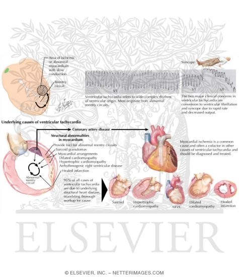 Ventricular Tachycardia