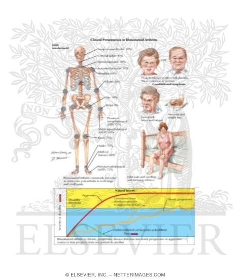Clinical Presentation In Rheumatoid Arthritis